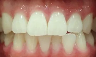 Overbite and Crowded Teeth treated with clear aligners before orthodontic treatment at Elate Orthodontics, case 3698