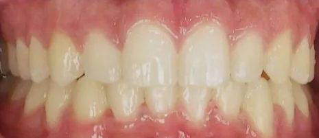 Overbite and Crowded Teeth treated with braces after orthodontic treatment at Elate Orthodontics, case 3718