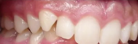 Overbite and Crowded Teeth treated with braces before orthodontic treatment at Elate Orthodontics, case 3718