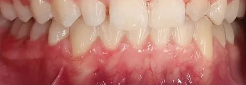 Overbite and Crowded Teeth treated with braces after orthodontic treatment at Elate Orthodontics, case 3912