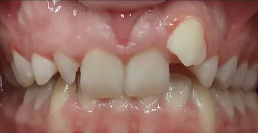 Overbite and Crowded Teeth treated with braces before orthodontic treatment at Elate Orthodontics, case 3912