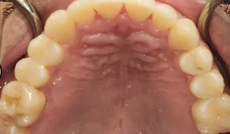 Overbite, Crowded Teeth and Overjet treated with clear aligners after orthodontic treatment at Elate Orthodontics, case 3968