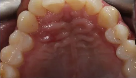 Overbite, Crowded Teeth and Overjet treated with clear aligners before orthodontic treatment at Elate Orthodontics, case 3968