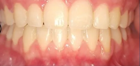 Overbite, Crowded Teeth and Overjet treated with clear aligners after orthodontic treatment at Elate Orthodontics, case 4006