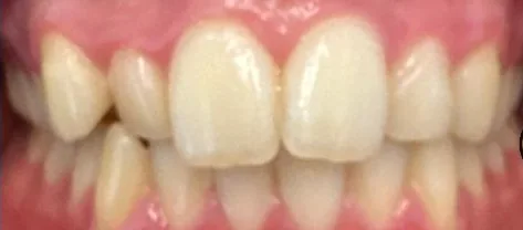 Overbite, Crowded Teeth and Overjet treated with clear aligners before orthodontic treatment at Elate Orthodontics, case 4006