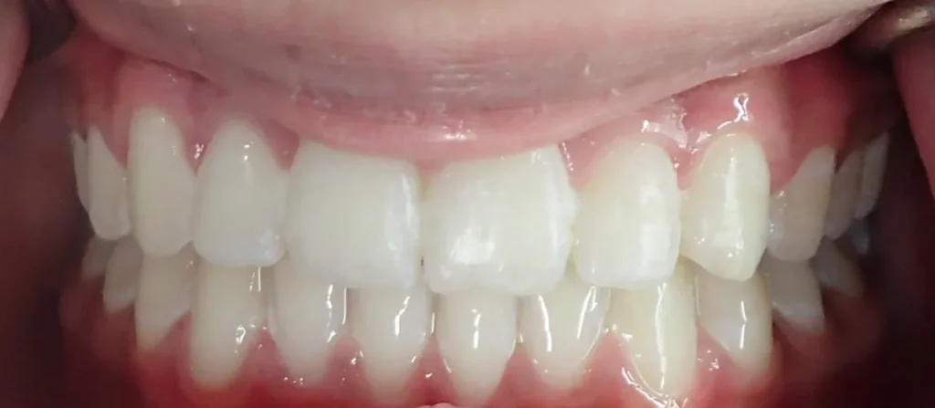 Overbite, Overjet and Gapped Teeth treated with braces after orthodontic treatment at Elate Orthodontics, case 3482