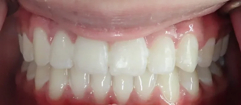 Overbite, Overjet and Gapped Teeth treated with braces after orthodontic treatment at Elate Orthodontics, case 3482