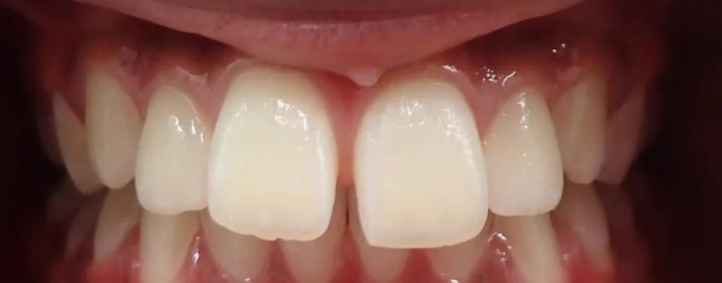Overbite, Overjet and Gapped Teeth treated with braces before orthodontic treatment at Elate Orthodontics, case 3482