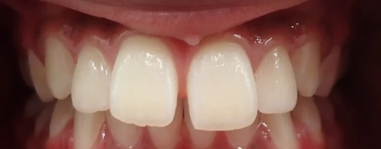 Overbite, Overjet and Gapped Teeth treated with braces before orthodontic treatment at Elate Orthodontics, case 3482