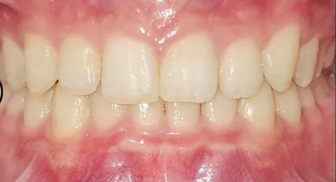 Overbite and Overjet treated with clear aligners after orthodontic treatment at Elate Orthodontics, case 3986