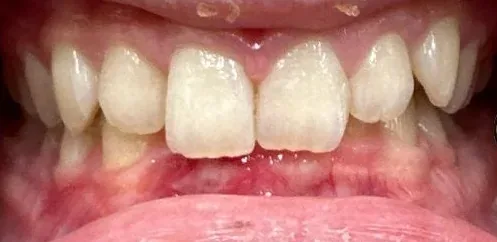 Overbite and Overjet treated with clear aligners before orthodontic treatment at Elate Orthodontics, case 3986
