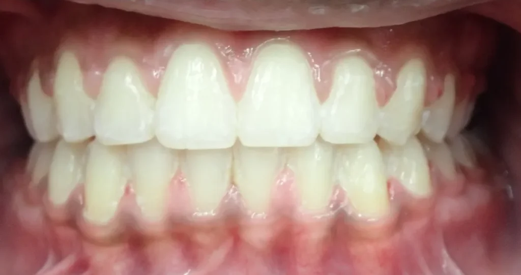 Overbite and Gapped Teeth treated with braces after orthodontic treatment at Elate Orthodontics, case 3478