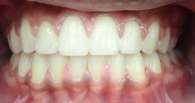 Overbite and Gapped Teeth treated with braces after orthodontic treatment at Elate Orthodontics, case 3478