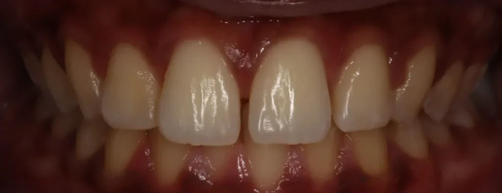 Overbite and Gapped Teeth treated with braces before orthodontic treatment at Elate Orthodontics, case 3478