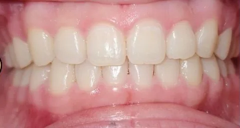 Overbite, Gapped Teeth and Overjet treated with clear aligners after orthodontic treatment at Elate Orthodontics, case 3550