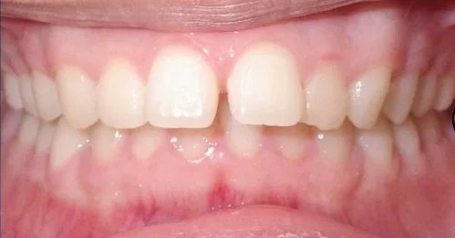 Overbite, Gapped Teeth and Overjet treated with clear aligners before orthodontic treatment at Elate Orthodontics, case 3550