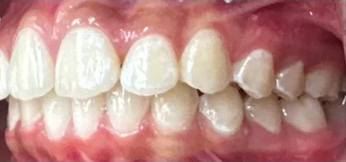 Overbite and Gapped Teeth treated with clear aligners after orthodontic treatment at Elate Orthodontics, case 3628