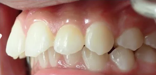 Overbite and Gapped Teeth treated with clear aligners before orthodontic treatment at Elate Orthodontics, case 3628