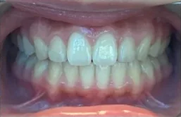 Overjet after orthodontic treatment at Elate Orthodontics, case 3520