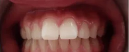 Overjet before orthodontic treatment at Elate Orthodontics, case 3520