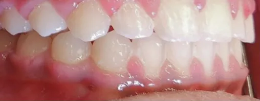 Overjet treated with braces after orthodontic treatment at Elate Orthodontics, case 3606