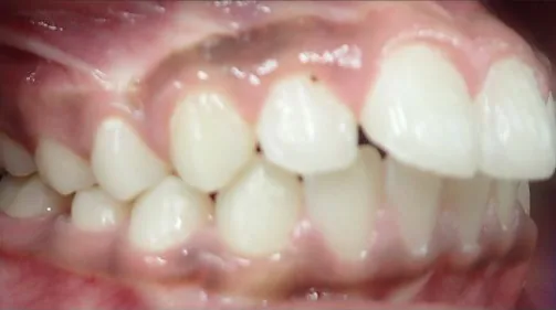 Overjet treated with braces before orthodontic treatment at Elate Orthodontics, case 3606