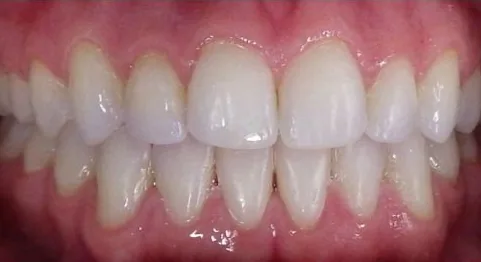 Orthodontic Relapse and Open Bite treated with clear aligners after orthodontic treatment at Elate Orthodontics, case 3652
