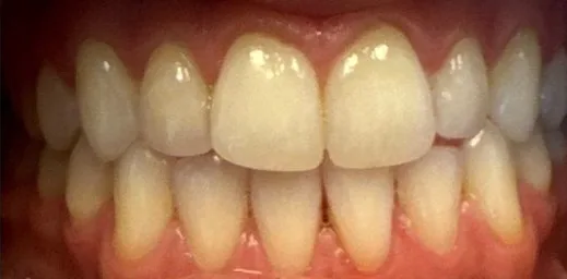 Orthodontic Relapse and Open Bite treated with clear aligners before orthodontic treatment at Elate Orthodontics, case 3652