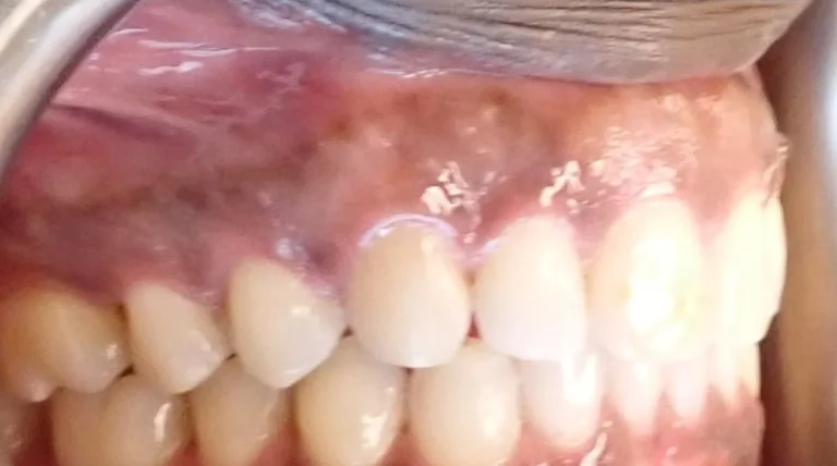 Gapped Teeth treated with clear aligners after orthodontic treatment at Elate Orthodontics, case 3442