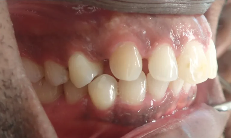 Gapped Teeth treated with clear aligners before orthodontic treatment at Elate Orthodontics, case 3442