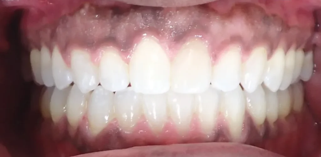 Gapped Teeth treated with braces after orthodontic treatment at Elate Orthodontics, case 3466