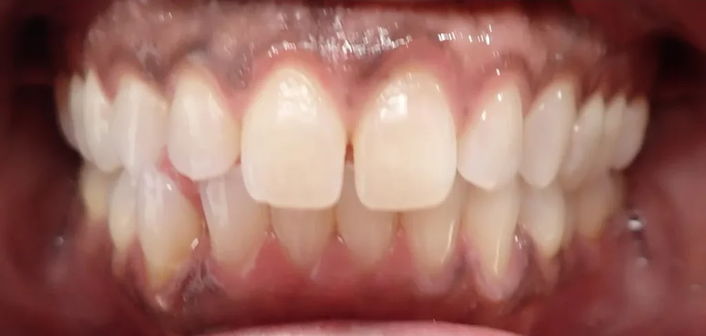 Gapped Teeth treated with braces before orthodontic treatment at Elate Orthodontics, case 3466