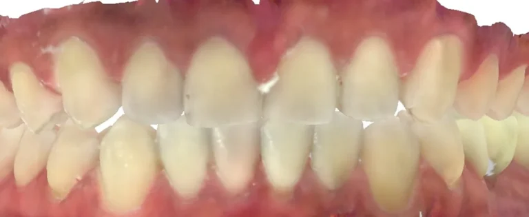 Gapped Teeth treated with clear aligners after orthodontic treatment at Elate Orthodontics, case 3470