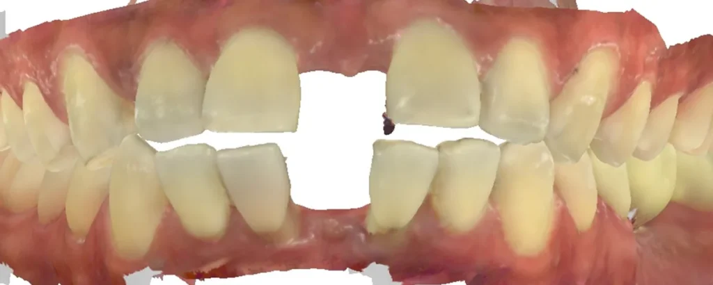 Gapped Teeth treated with clear aligners before orthodontic treatment at Elate Orthodontics, case 3470