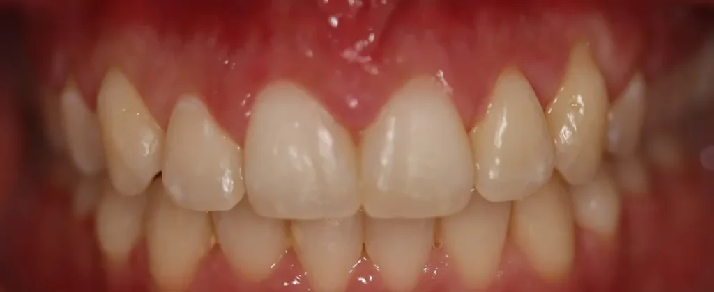 Gapped Teeth after orthodontic treatment at Elate Orthodontics, case 3624