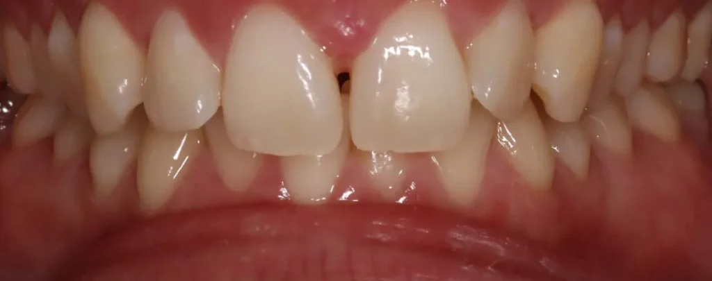 Gapped Teeth before orthodontic treatment at Elate Orthodontics, case 3624
