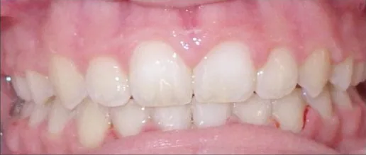 Gapped Teeth, Crowded Teeth and Overbite treated with braces after orthodontic treatment at Elate Orthodontics, case 3682