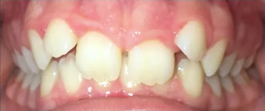 Gapped Teeth, Crowded Teeth and Overbite treated with braces before orthodontic treatment at Elate Orthodontics, case 3682