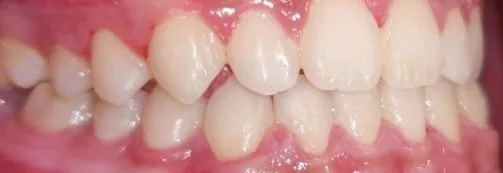 Gapped Teeth and Edge-to-Edge Bite treated with clear aligners after orthodontic treatment at Elate Orthodontics, case 3944
