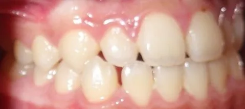 Gapped Teeth and Edge-to-Edge Bite treated with clear aligners before orthodontic treatment at Elate Orthodontics, case 3944