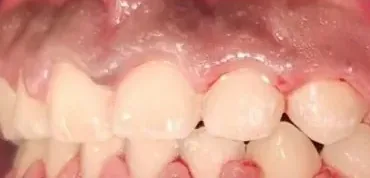 Gapped Teeth and Edge-to-Edge Bite treated with braces after orthodontic treatment at Elate Orthodontics, case 4030