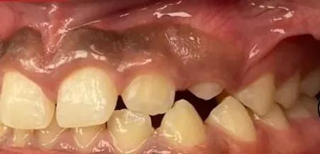 Gapped Teeth and Edge-to-Edge Bite treated with braces before orthodontic treatment at Elate Orthodontics, case 4030
