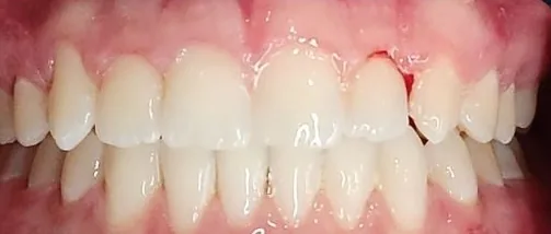 Gapped Teeth, Edge-to-Edge Bite and Overbite treated with clear aligners after orthodontic treatment at Elate Orthodontics, case 4054