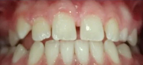 Gapped Teeth, Edge-to-Edge Bite and Overbite treated with clear aligners before orthodontic treatment at Elate Orthodontics, case 4054