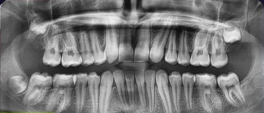 Gapped Teeth and Missing Teeth treated with braces after orthodontic treatment at Elate Orthodontics, case 4010