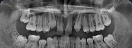 Gapped Teeth and Missing Teeth treated with braces before orthodontic treatment at Elate Orthodontics, case 4010