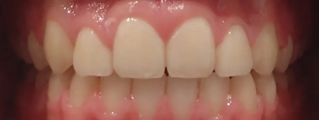 Gapped Teeth and Open Bite after orthodontic treatment at Elate Orthodontics, case 3446