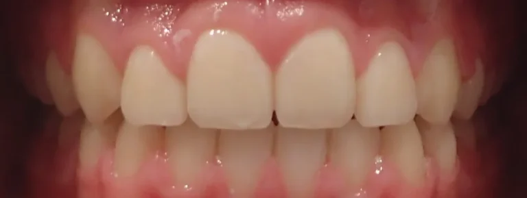 Gapped Teeth and Open Bite after orthodontic treatment at Elate Orthodontics, case 3446