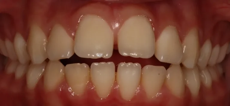 Gapped Teeth and Open Bite before orthodontic treatment at Elate Orthodontics, case 3446