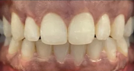 Gapped Teeth and Open Bite treated with clear aligners after orthodontic treatment at Elate Orthodontics, case 3788
